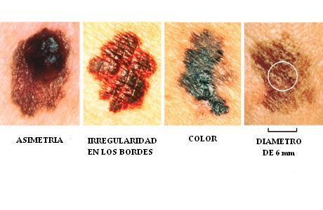 cancer-piel-melanoma-probremajpg.JPG